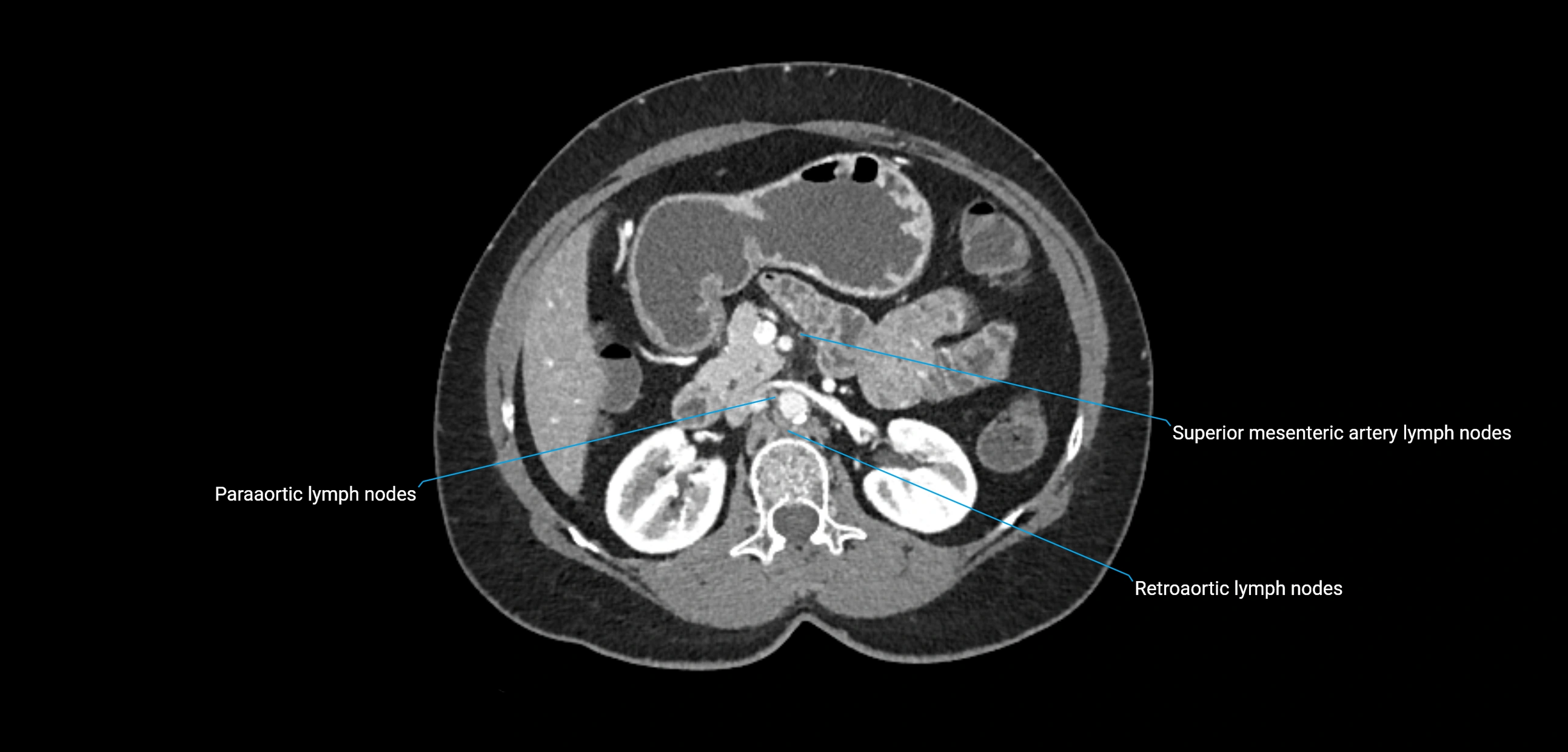 CT ct abdominal lymph nodes  axial cross sectional anatomy  enchanced radiology image -img-00002-00174.webp